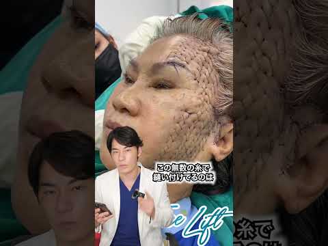 整形失敗…? やばいフェイスリフト #shorts