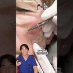 ピコレーザーのシミ取りってぶっちゃけどうなの？#shorts #シミ取り #シミ取り放題