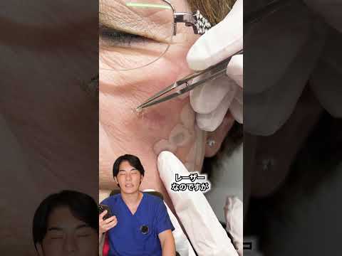 ピコレーザーのシミ取りってぶっちゃけどうなの？#shorts #シミ取り #シミ取り放題