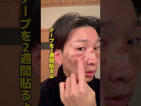 シミ取り放題 @Peach美容クリニック #美容 #福岡はシミ取り